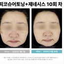 정진통상 | 피코슈어 가격 안 아깝게 기미 주근깨 제대로 없애는 팁