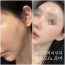 꽃보다 멍 | 압구정역피부과 인모드 포마 fx 소두 만들기 성공후기 멍자국은 언제까지?