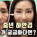 #하안검이 고민이라면 주목!! 4일차 실밥제거 ~ 1개월 후의 모습까지 모두 공개합니다! 이미지