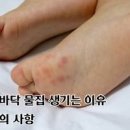 발바닥 물집 생기는 이유 효능 및 증상 관리법 이미지