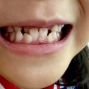 동탄본치과의원 | 동탄 어린이 교정 치과 반대교합 페이스 마스크 교정 일기 1탄