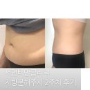 할렐루야타이어 | 부산에서 유명한 서면비만클리닉에서 복부지방분해주사 2주차 뜨끈한 찐후기