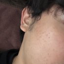 용하다한의원 | [강남한의원 새살침] 아이스픽/박스카/롤링 여드름 흉터 2회차 찐후기 통증, 멍, 다운타임 과정...