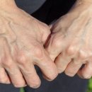 젊은 나이에 손등에 튀어나온 핏줄혈액순환 장애로 생기는' 손등 정맥류' 이미지