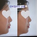 인비절라인 교정 수유 교정치과 상담 후기｜어금니 4개 발치 교정 시작 (내돈내산)