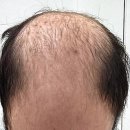 양동고려의원 | 후기로 보는 두타스테리드 탈모치료 효과