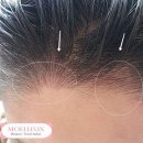 미헤어라인 이미지