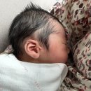 지디에스성형외과의원 | [생후77일]스킨텍 제거 수술후기