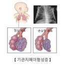 폐 이형성증(Bronchopulmonary dysplasia) 이미지