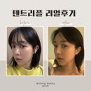 강남 피부과 텐트리플 후기｜중안부 리프팅 효과·전후 내돈내산 리뷰