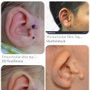 베스탑비뇨기과의원 | 부이개 수술 비용 비교 (아문성형외과 경희의료원 경희대 범진식 교수님) 귀젖 스킨텍