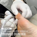 대구 티눈 제거 내성발톱교정 전문 바바뷰티 아카데미