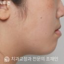 정인치과의원 | 신검단중앙역 교정치과 | 12세에도 턱교정이 가능할까요? 턱교정 적기를 놓쳤다면? 12세 반대교합 치료...