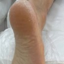 망포동발각질관리 겨울발뒤꿈치관리는 레푸스망포