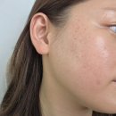 루비 | 강남 논현역피부과 루비레이저 주근깨제거 후기 (효과, 가격)