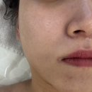 홍산초등학교 | [전주피부관리] 전주홍조관리 잘하는 에리엘에스테틱에서 열감진정관리 후기
