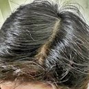 우리집의원 | 파주 우리집의원 찐 후기 + 탈모관리법