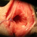 서혜부 탈장(Inguinal hernia) 이미지