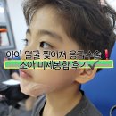 서초 서울 마더스 | 👶 아이 얼굴 찢어짐, 어디서 수술했을까?서초 마더스성형외과 소아 미세봉합 수술 후기 + 비용/과정 공개