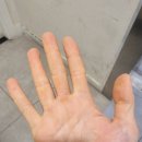 서정튼튼정형외과의원 | 서정리역 손가락 통증으로 방문한 튼튼정형외과