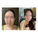 향남피부과 온다리프팅 이중턱 후기 :: 다래한방병원 피부클리닉