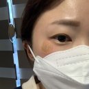 [내돈내산] 봄스피부과(구 맑은참피부과) 흑자제거 시술후기 #1