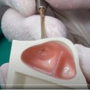 NR-3[진주대로]-상-78 | 고난도 상악동거상술, 술자 경험이 풍부하면 10분컷