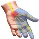 중년(中年) 여성(女性)에게 찾아오는 손목 수근관증후군(手筋管症候群) 이미지