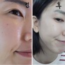 대구 동성로 피부과 &#39;스킨보톡스&#39; 얼굴전체 전후 효과 후기