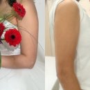 더웨이성형외과의원 | 여름맞이 더웨이성형외과 바디 지방분해주사 팔뚝 후기