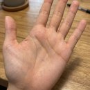 생생헤어 | 강남밴스모자이너 헤어라인교정 생생 후기! 여자모발이식 후 집에서 관리하는 꿀팁