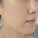 쁘띠케이의원 | 🎆"루비레이저" 후기, 주의사항, 부작용, 셀앤케이 피부과 (내돈내산, 대가성X)