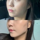 600 | 대구 동성로 올타이트리프팅 최초 도입한 곳에서 받은 600샷 후기