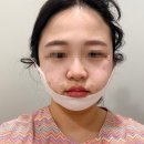 강남성형외과 실루엣소프트 밸런스리프팅, 팔자+심부볼 고민 한 번에 잡은 내돈내산 후기!!!