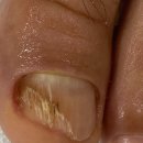 레푸스인하대역점 내성발톱 무좀발톱 발각질 문제성발 이미지