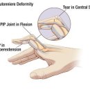 류마티스 관절염(Rheumatoid Arthritis)의 치료 이미지