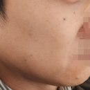 인모드효과 처진투턱 볼살 구로리프팅 병원 후기