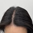 영양센타압구정점 | 압구정 탈모치료 헤어셀 &amp; 모낭주사 후기