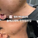 청라 - 달성군 | 청라여드름관리 솔에스테틱 여드름 압출 잘하는곳 청라피부관리 후기