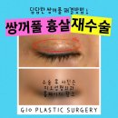 쌍꺼풀 흉살, 함몰흉 때문에 울퉁불퉁한 라인 이미지