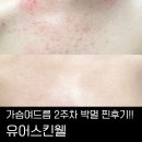 약초약국 | 검단피부관리 가슴여드름 유어스킨웰 약초필 2주일 변화 대만족 찐후기