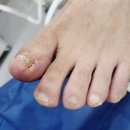 비트플렉스약국 | 동대문구 발톱무좀 치료 실비 가능한 레이저 풋센터 치료 후기