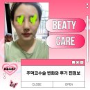 소유원 | 주먹코수술 변화와 후기 찐정보