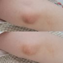 대구 팔꿈치 미백 멜라닌 케어 후기 두피를 디자인하는 여자