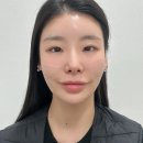 바로서면병원 | 부산 서면 리프팅 | 온다리프팅 6만줄 받고 온 솔직 후기 (통증 • 효과 O)