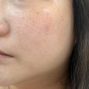 라온코스메디컬 | 파주피부관리 색소침착에 효과적인 플라즈마관리 운정 라온에스테틱에서 받았어요