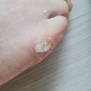 20년을 괴롭힌 발 볼의 티눈 제거 시도 후기(혐짤 주의) - 티눈밴드, 티눈고 성능 좋아졌네~