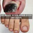 문제성 손발톱 전문관리 케어톱톱
