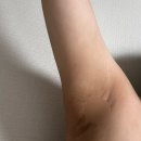 분당-82 | 분당미라드라이 겨드랑이 땀 냄새 통증 가격 리얼 후기