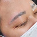푸르게 | 회색 눈썹 잔흔 제거 후기｜푸르게 남은 눈썹 문신, 깔끔하게 지울 수 있을까요?